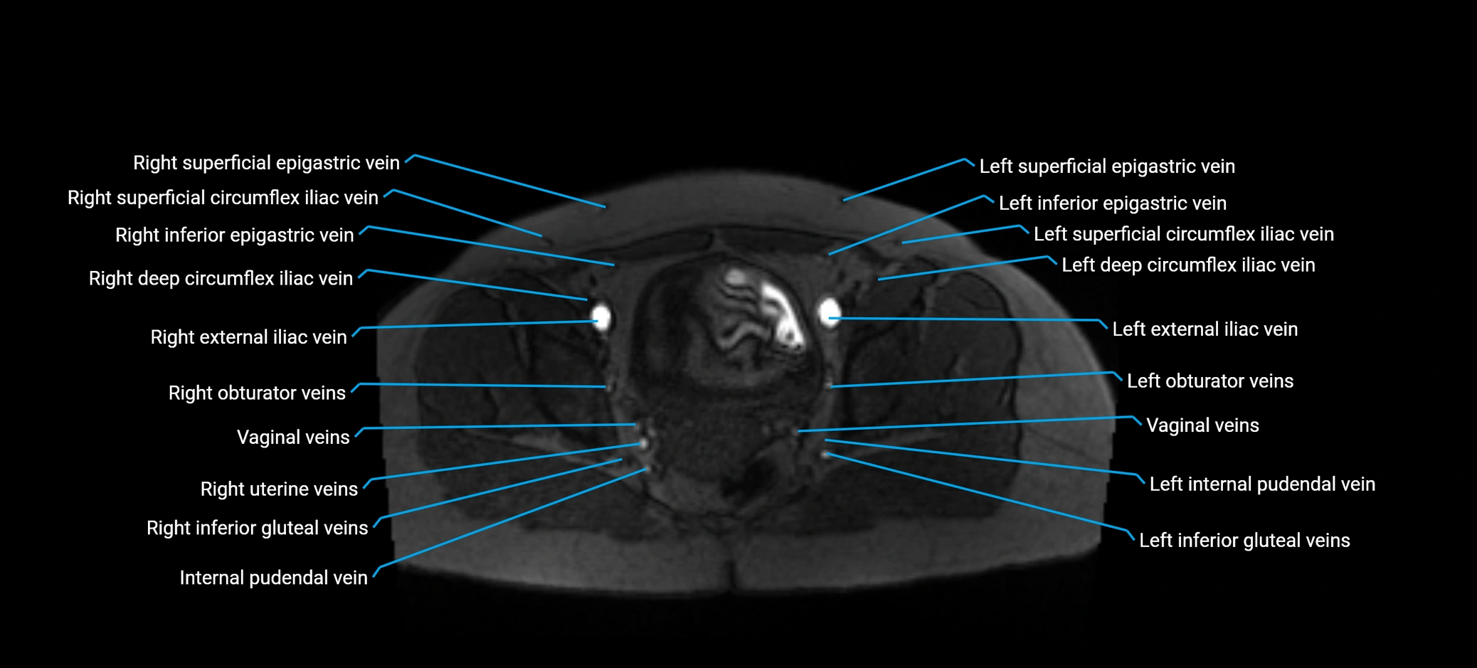 MRV abdomen pelvis & lower limb axial cross sectional anatomy labelled MRI image 170 (1).webp